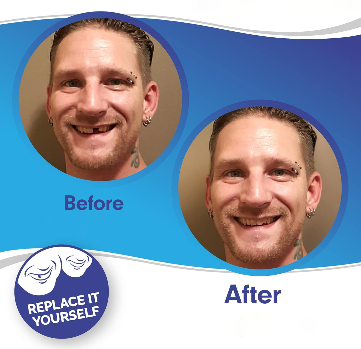 Smile Veneer (Upper & Lower Included) 1