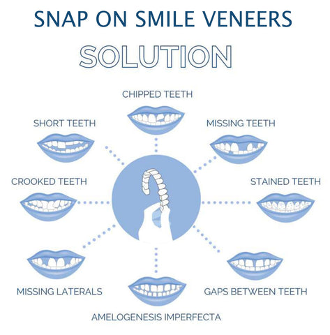 Smile Veneer (Upper & Lower Included) 5