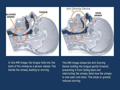 Apnea Tongue Stabilizing Device 3