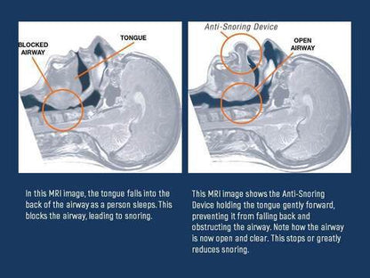 Apnea Tongue Stabilizing Device 3