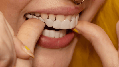 Instant smile transformation with Snap on Smile Veneers 6
