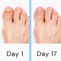 Nail Laser Fungus Device 3