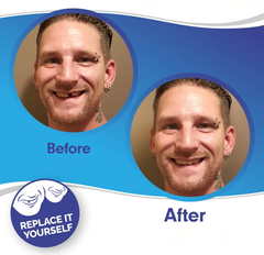 Smile Veneer (Upper & Lower Included) 1