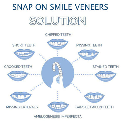 Smile Veneer (Upper & Lower Included) 5