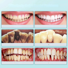 FreshScale - Ultrasound Plaque & Tartar Eliminator-3